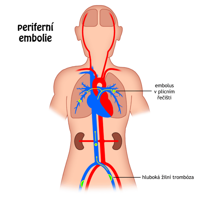 Jak vyloucit plicní embolii?